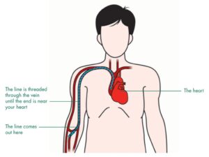 PICC line