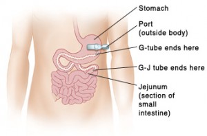 Feeding Tube J tube Jejunal feeding