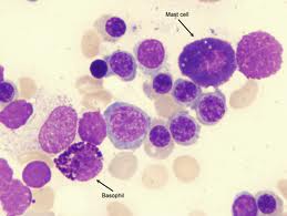 Mast cells | Mastocytosis